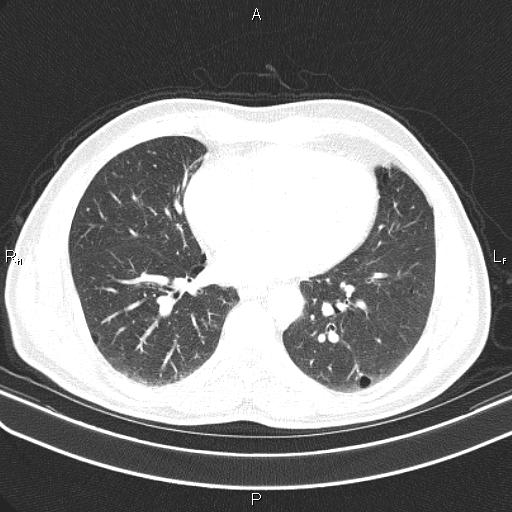 File:Colon cancer (Radiopaedia 85663-101443 Axial lung window 41).jpg