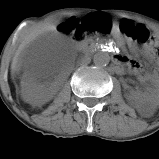 Colon cancer with calcified liver metastasis (Radiopaedia 74423-85309 Axial non-contrast 43).jpg