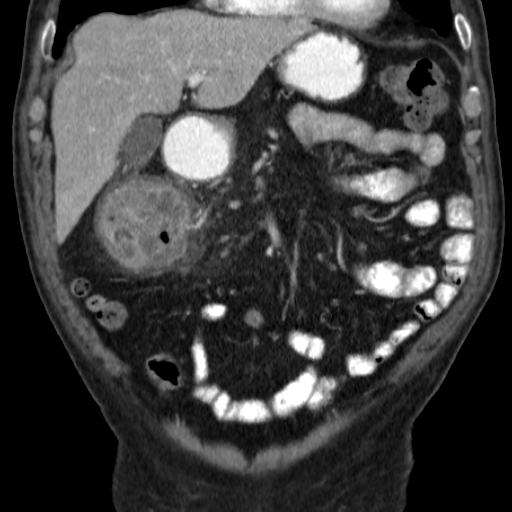 File:Colon cancer with duodenal invasion (Radiopaedia 16278-15958 B 19).jpg