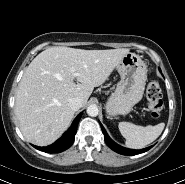 Colon carcinoma with hepatic metastases (Radiopaedia 29477-29961 A 23).jpg
