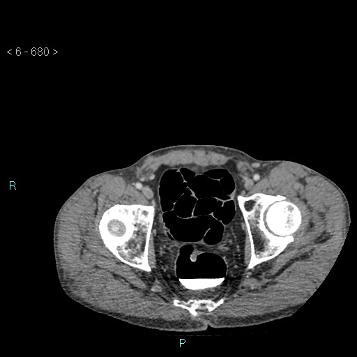 File:Colonic cancer (ultrasound and TC imaging) (Radiopaedia 50346-55713 A 132).jpg
