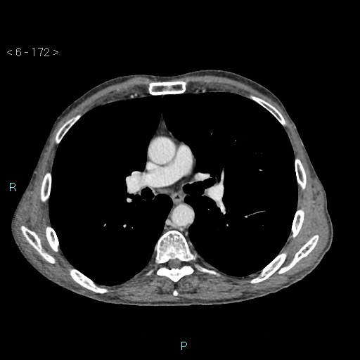 Colonic cancer (ultrasound and TC imaging) (Radiopaedia 50346-55713 B 172).jpg