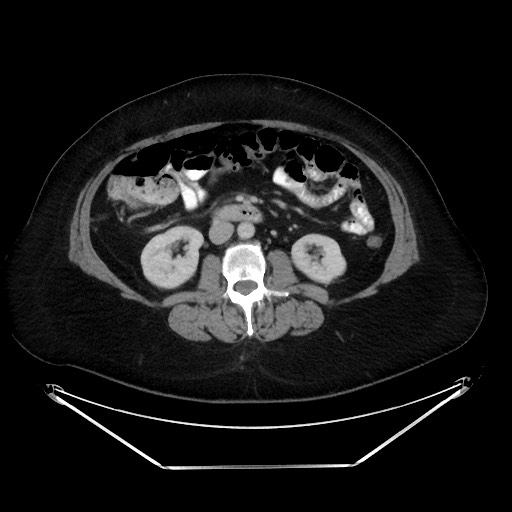 File:Colonic intussusception due to adenocarcinoma (Radiopaedia 86828-102987 A 73).jpg