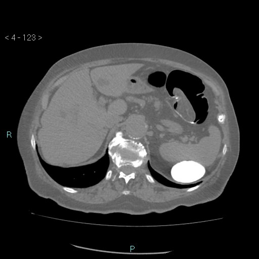 File:Colonic lipomas (Radiopaedia 49137-54244 Axial bone window 55).jpg