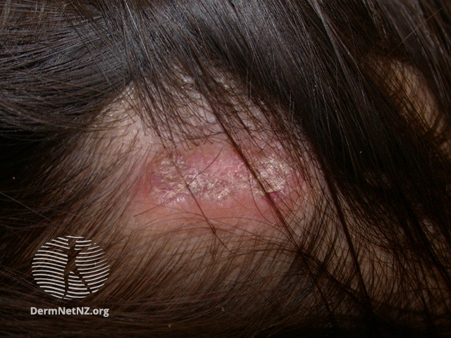 Cutaneous lupus erythematosus (DermNet NZ immune-lupus-erythematosus-2572).jpg