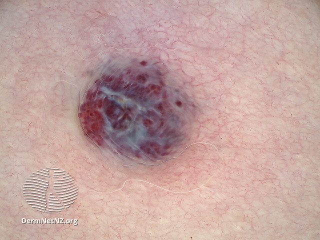 File:Dermoscopy of angiokeratoma of Fordyce on vulva (DermNet NZ angiokeratoma-45).jpg
