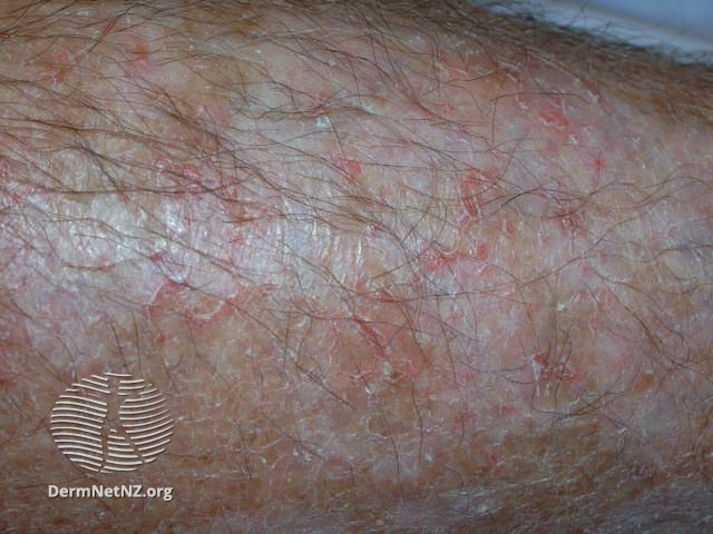 File:Eczema craquelé (DermNet NZ dermatitis-eczema-craquele4).jpg