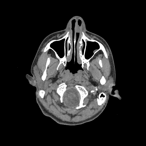 Nasal pyogenic granuloma (lobular capillary hemangioma) (Radiopaedia 85536-101244 Axial non-contrast 30).jpg
