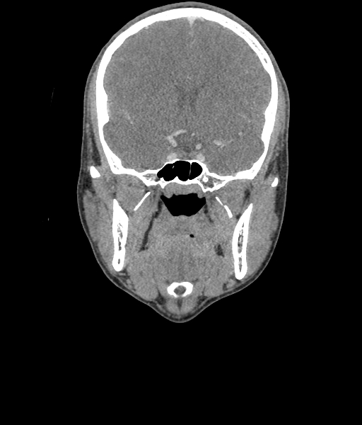 Nasal pyogenic granuloma (lobular capillary hemangioma) (Radiopaedia 85536-101244 D 59).jpg