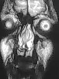 File:Nasal septum hematoma (Radiopaedia 6778-7968 H 1).jpg