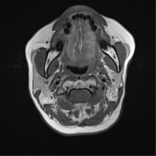 File:Nasopharyngeal carcinoma with cerebral abscess (Radiopaedia 43018-46273 Axial T1 26).png