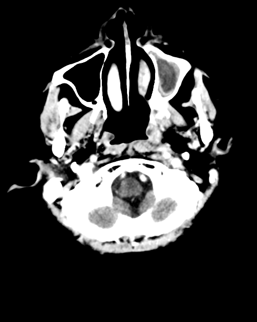 Nasopharyngeal carcinoma with cerebral abscess (Radiopaedia 43018-46275 Axial C+ delayed 7).png