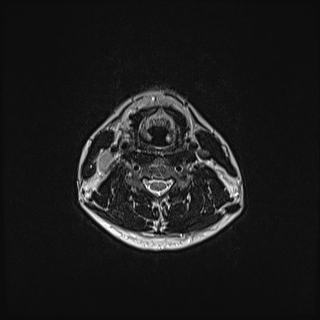 Nasopharyngeal carcinoma with perineural spread (Radiopaedia 55030-61380 Axial T2 59).jpg
