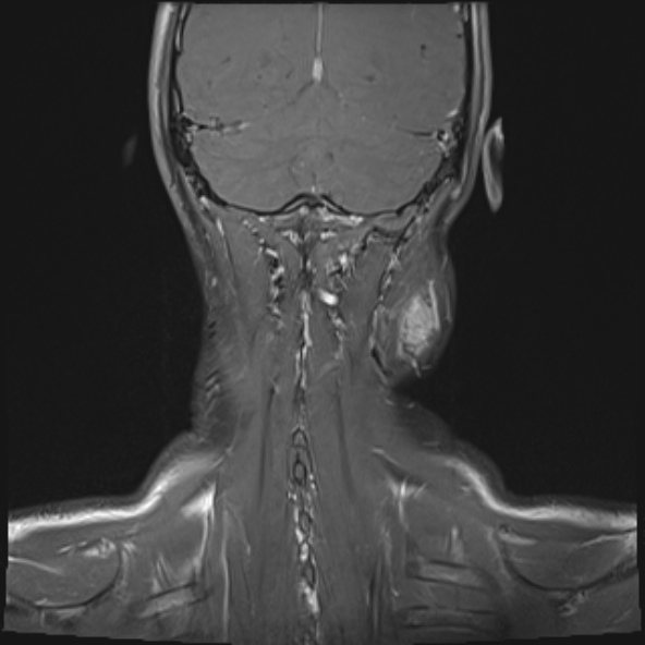 Nasopharyngeal carcinoma with skull base invasion (Radiopaedia 53415-59485 E 1).jpg