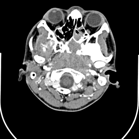 File:Nasopharyngeal carcinoma with skull base invasion (Radiopaedia 53415-59705 A 31).jpg