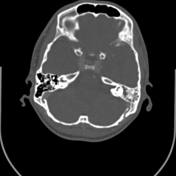 Nasopharyngeal carcinoma with skull base invasion (Radiopaedia 53415-59705 Axial bone window 6).jpg