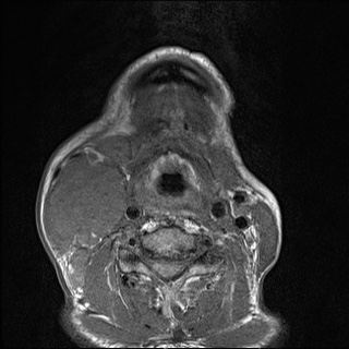 Nasopharyngeal carcinoma with skull base invasion (Radiopaedia 59258-66600 B 49).jpg