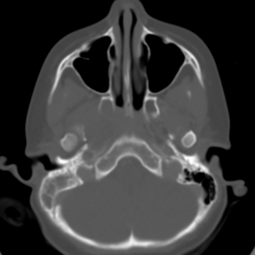 File:Nasopharyngeal rhabdomyosarcoma (Radiopaedia 23417-23491 Axial bone window 8).jpg