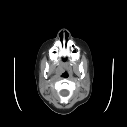File:Nasopharyngeal rhabdomyosarcoma (Radiopaedia 23417-23491 Axial non-contrast 1).jpg