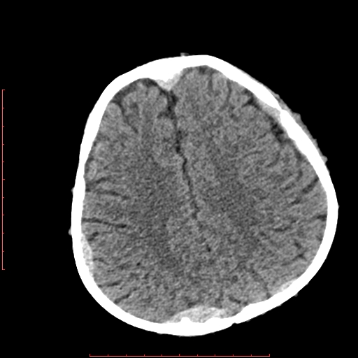 File:Neuroblastoma skull metastasis (Radiopaedia 56053-62683 Axial non-contrast 12).jpg