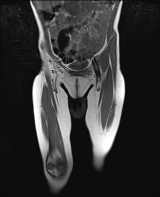 File:Neuroblastoma with bone metastases (Radiopaedia 67080-76414 Coronal T1 5).jpg
