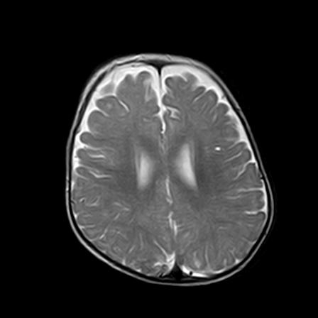 File:Neurofibromatosis type 1 (Radiopaedia 30089-30671 Axial T2 16).jpg