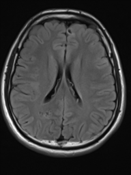 File:Neurofibromatosis type 2 (Radiopaedia 44936-48838 Axial FLAIR 15).png