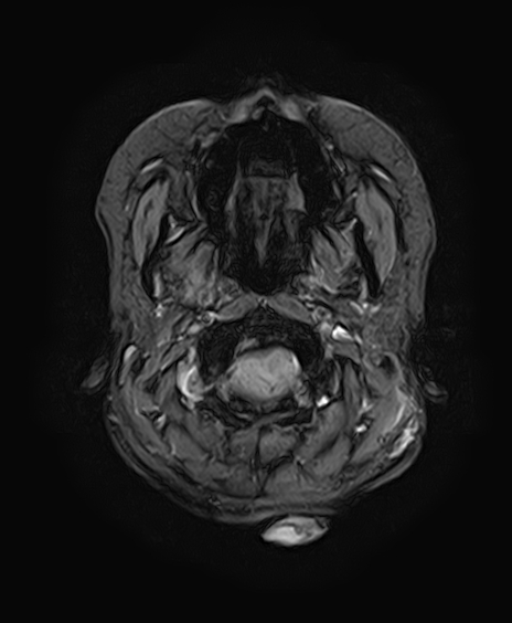 File:Neurofibromatosis type 2 (Radiopaedia 66211-75401 Axial Gradient Echo 6).jpg