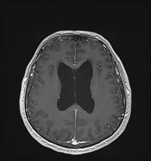 Neurofibromatosis type 2 (Radiopaedia 79097-92049 Axial T1 C+ 126).jpg