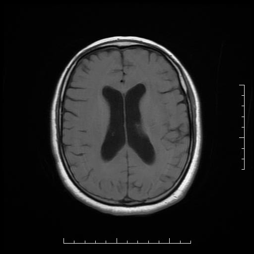 File:Neuroglial cyst of brainstem (Radiopaedia 29134-29526 Axial T1 13).jpg