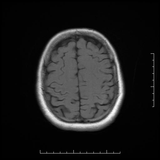 File:Neuroglial cyst of brainstem (Radiopaedia 29134-29526 Axial T1 17).jpg