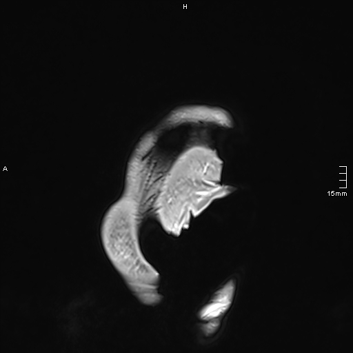 Neurosarcoidosis - involvement of the mesial temporal lobes (Radiopaedia 67429-76820 Sagittal T1 C+ 1).jpg