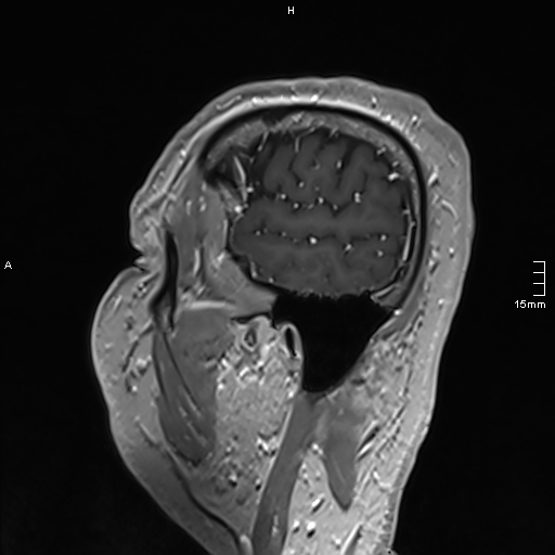 Neurosarcoidosis - involvement of the mesial temporal lobes (Radiopaedia 67429-76820 Sagittal T1 C+ 26).jpg