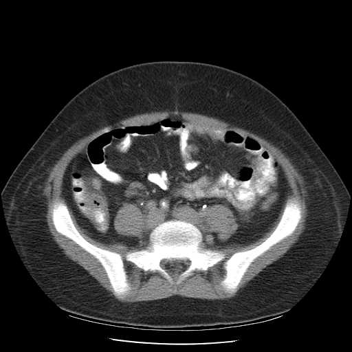 File:Non-Hodgkin lymphoma involving pelvis (Radiopaedia 21281-21197 B 44).jpg