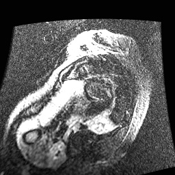 File:Non-compaction of the left ventricle (Radiopaedia 38868-41062 E 1).jpg