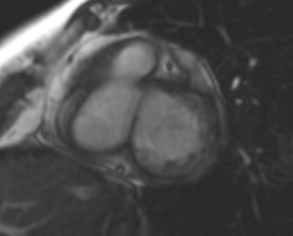 File:Non-compaction of the left ventricle (Radiopaedia 69436-79314 Short axis cine 169).jpg