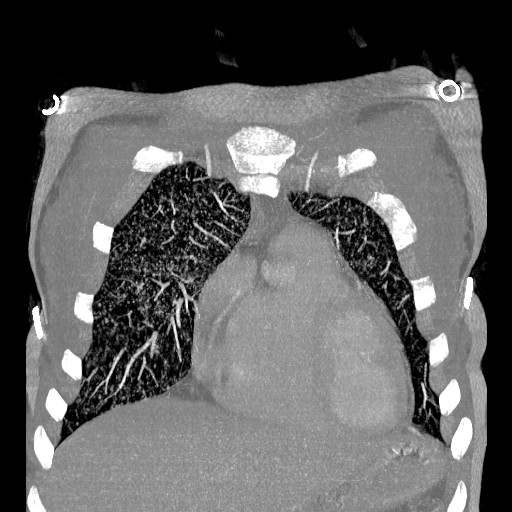 File:Non-small cell lung cancer with miliary metastases (Radiopaedia 23995-24193 Coronal lung window 3).jpg