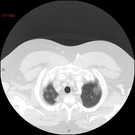 File:Non-specific interstitial pneumonitis (Radiopaedia 27044-27222 Axial lung window 49).jpg