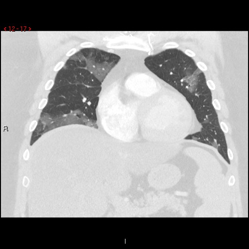 File:Non-specific interstitial pneumonitis (Radiopaedia 27044-27222 Coronal lung window 17).jpg