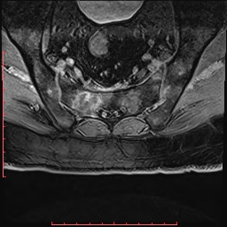 Non Hodgkin's lymphoma with metastasis to spine (Radiopaedia 54844-61103 Axial T1 C+ fat sat 38).jpg