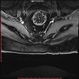 Non Hodgkin's lymphoma with metastasis to spine (Radiopaedia 54844-61103 Axial T1 C+ fat sat 51).jpg