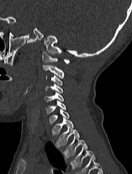Normal CT cervical spine - pediatric (Radiopaedia 52549-58462 Sagittal bone window 52).jpg