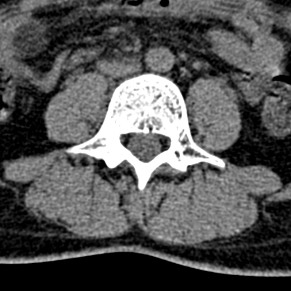 Normal CT lumbar spine (Radiopaedia 53981-60118 Axial non-contrast 63).jpg
