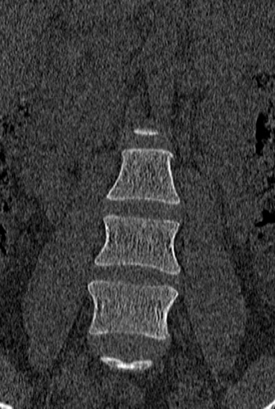 File:Normal CT lumbar spine (Radiopaedia 53981-60118 Coronal bone window 13).jpg