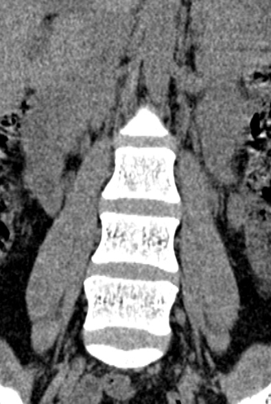 Normal CT lumbar spine (Radiopaedia 53981-60118 F 22).jpg