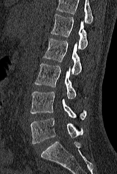 File:Normal CT lumbar spine (Radiopaedia 53981-60118 Sagittal bone window 43).jpg