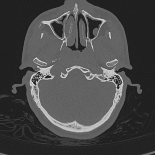Normal CT skull (Radiopaedia 40798-43459 A 28).png