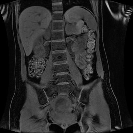 Normal MRI abdomen in pregnancy (Radiopaedia 88001-104541 M 89).jpg