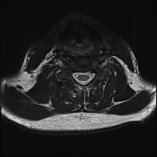File:Normal MRI cervical spine (infection protocol) (Radiopaedia 53916-60039 Axial T2 32).png