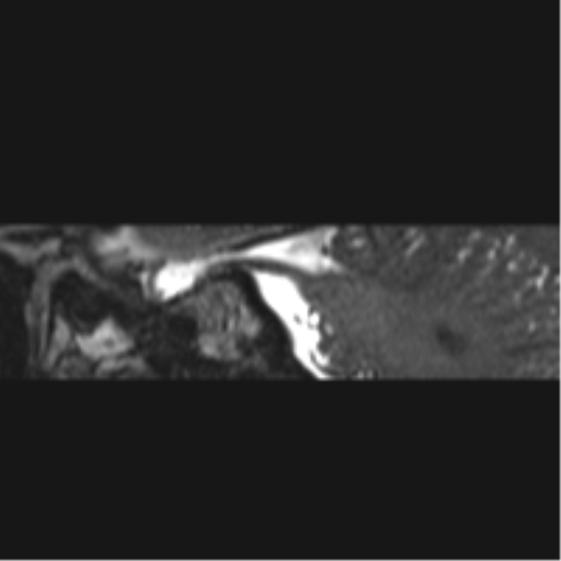 Normal MRI internal auditory canal (Radiopaedia 41613-44525 C 43).png